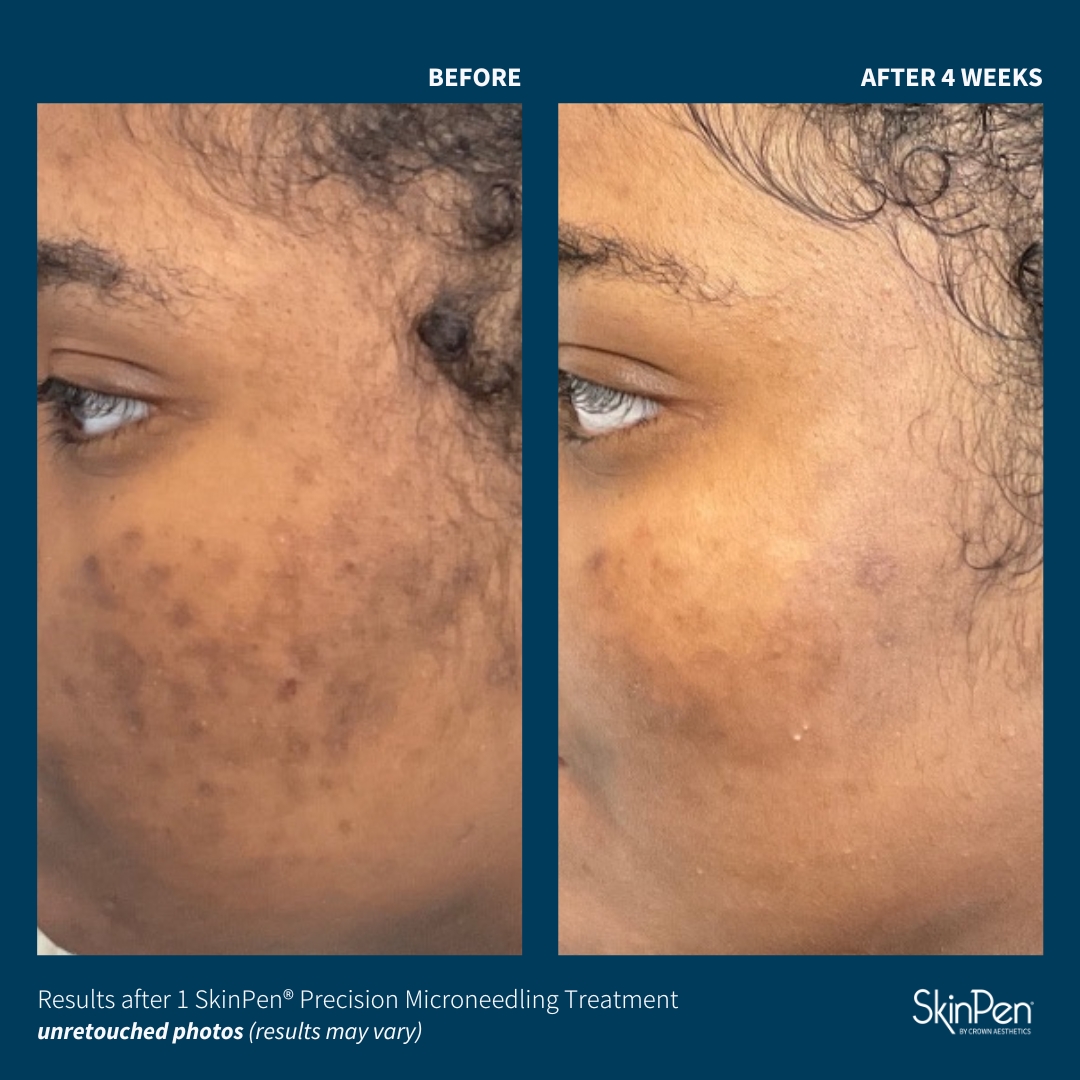 Before and After Image: SkinPen Microneedling - left-front-oblique