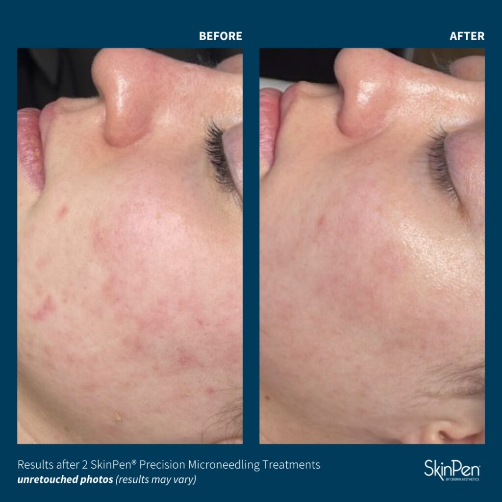Before and After Image: SkinPen Microneedling - left-side