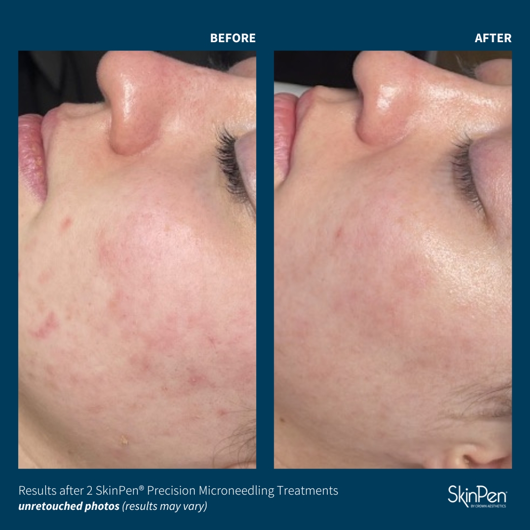Before and After Image: SkinPen Microneedling - left-side