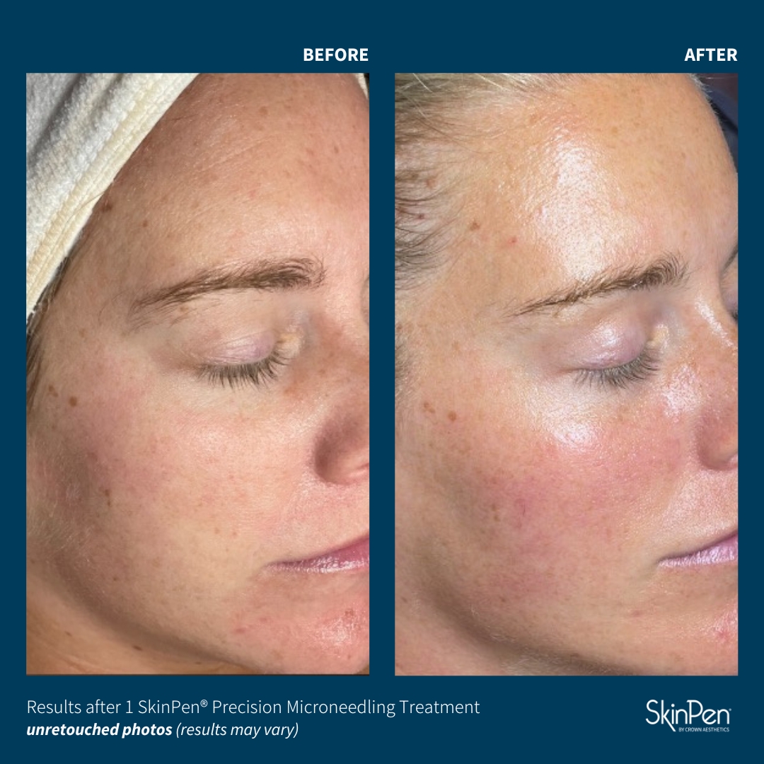 Before and After Image: SkinPen Microneedling - right-front-oblique