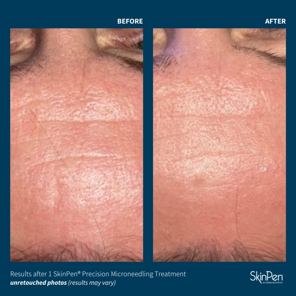 Before and After Image: SkinPen Microneedling - front