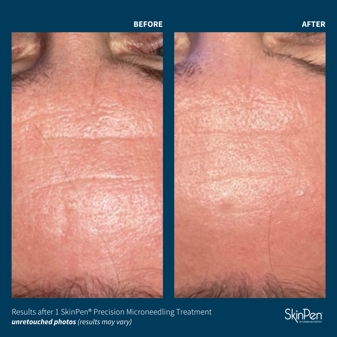 Before and After Image: SkinPen Microneedling - front