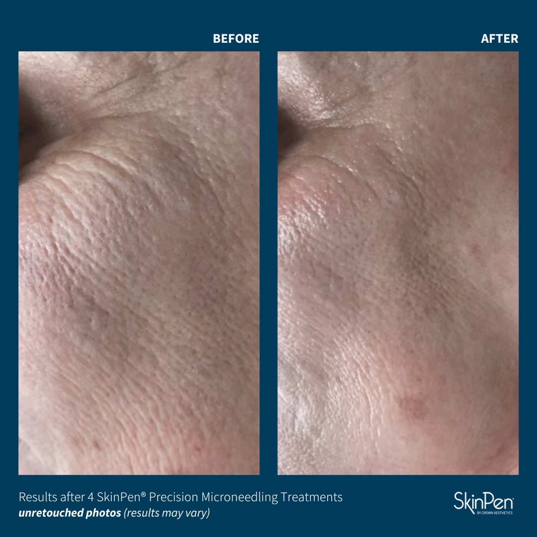 Before and After Image: SkinPen Microneedling - left-side