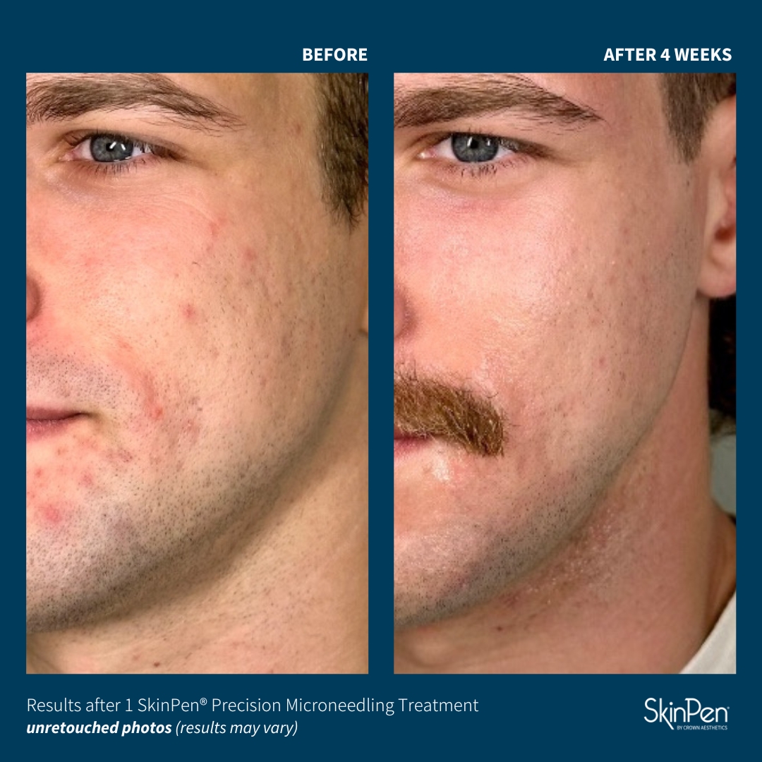 Before and After Image: SkinPen Microneedling - left-front-oblique