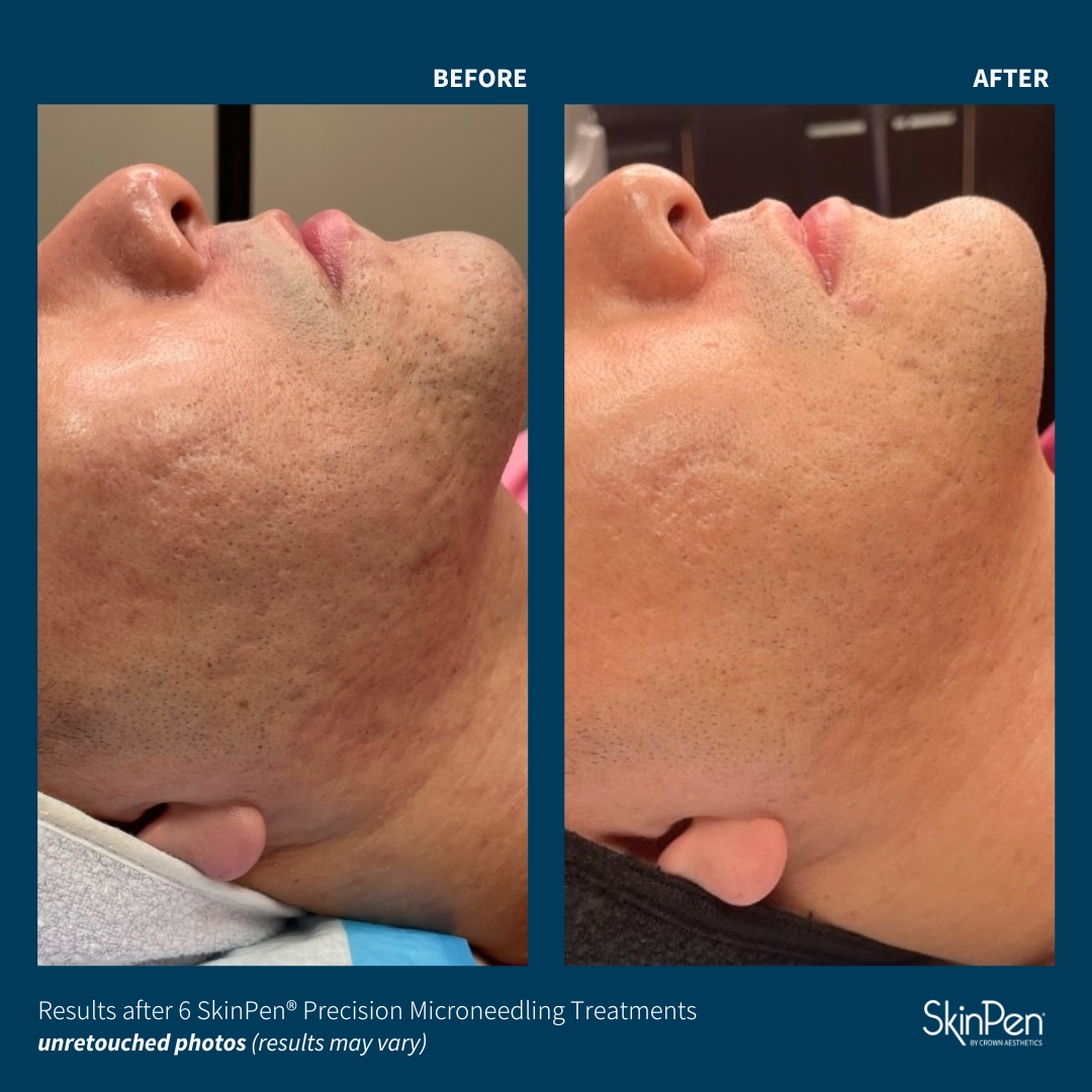 Before and After Image: SkinPen Microneedling - front