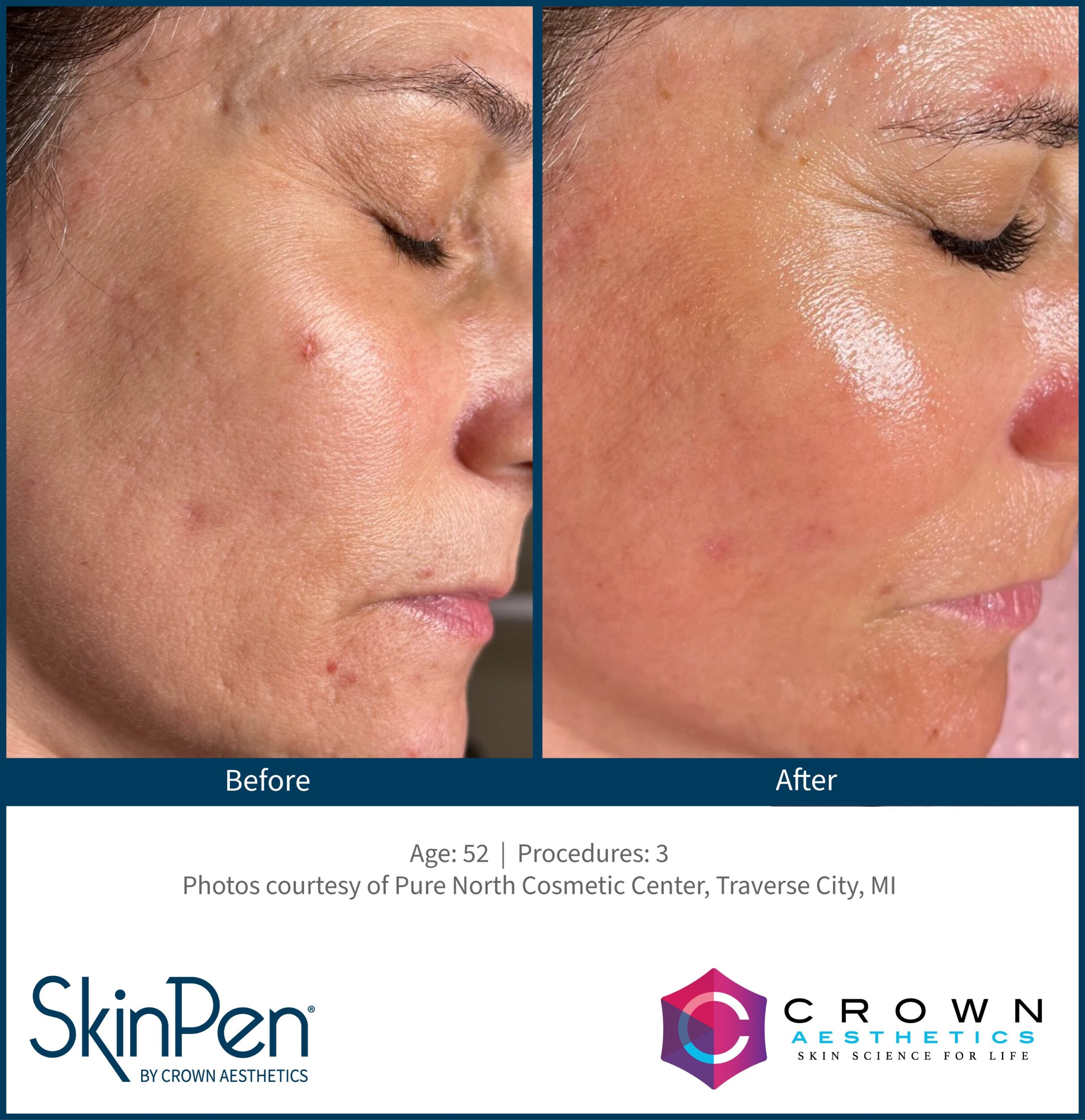 Before and After Image: SkinPen Microneedling - right-front-oblique