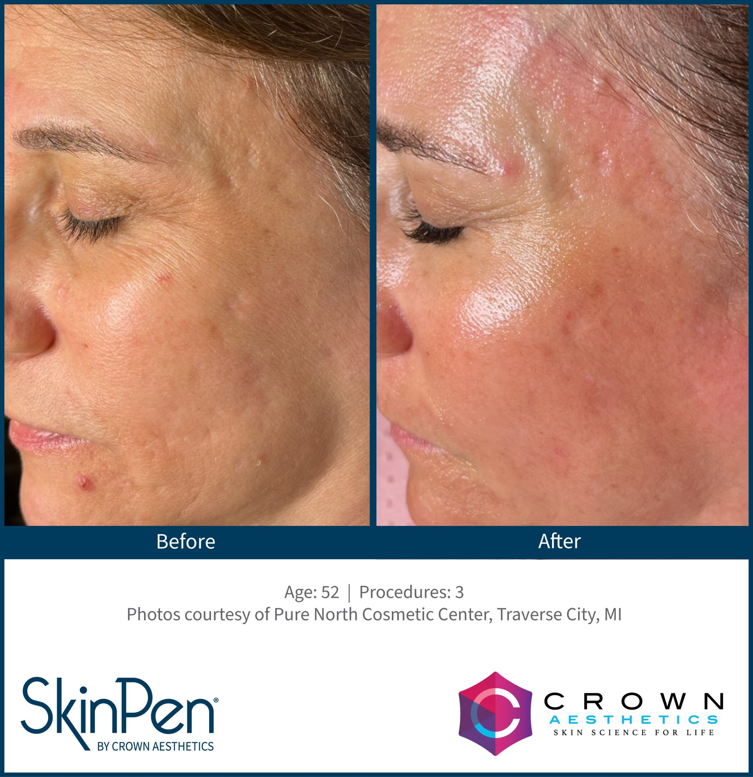 Before and After Image: SkinPen Microneedling - left-front-oblique