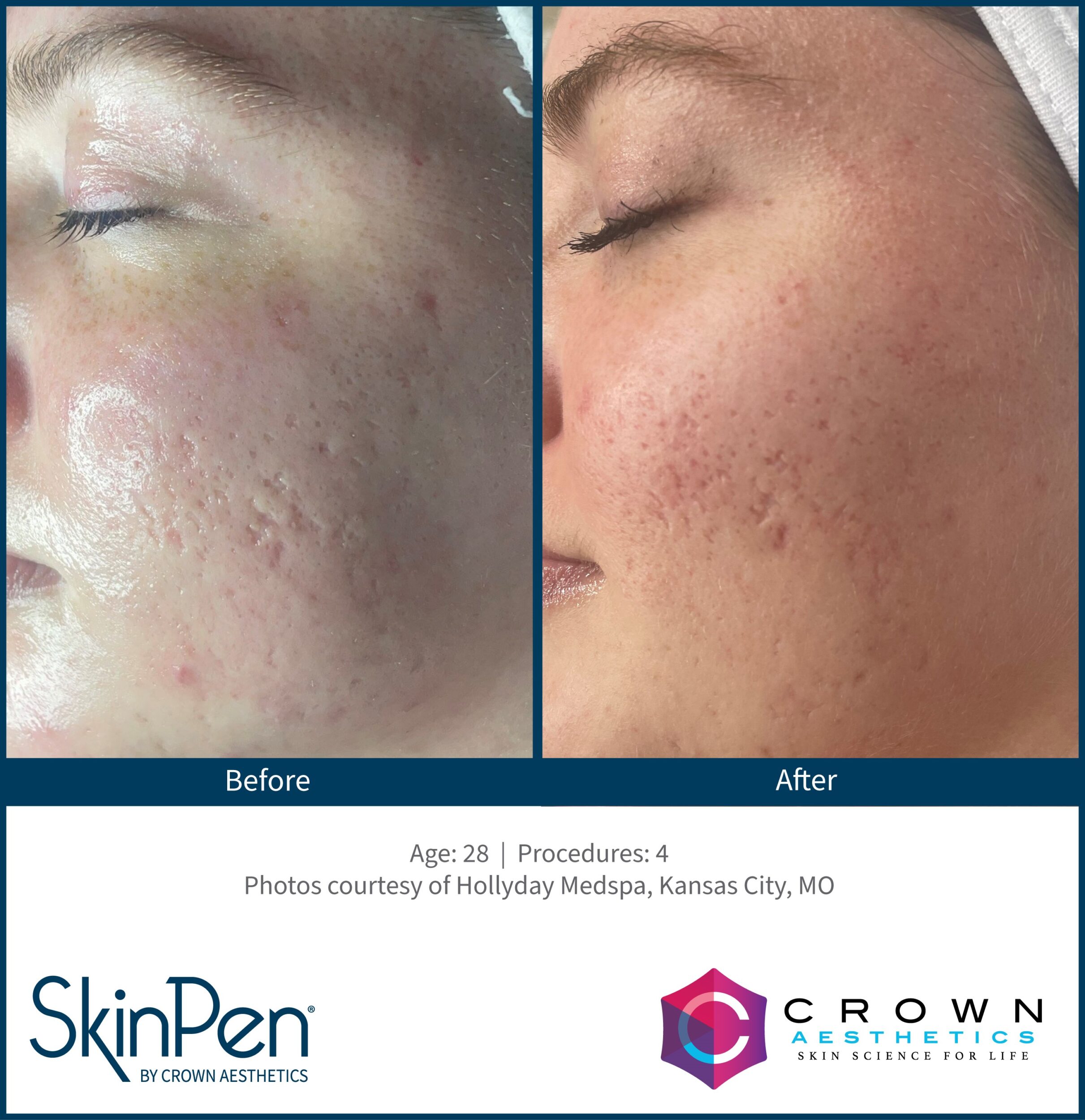 Before and After Image: SkinPen Microneedling - left-front-oblique