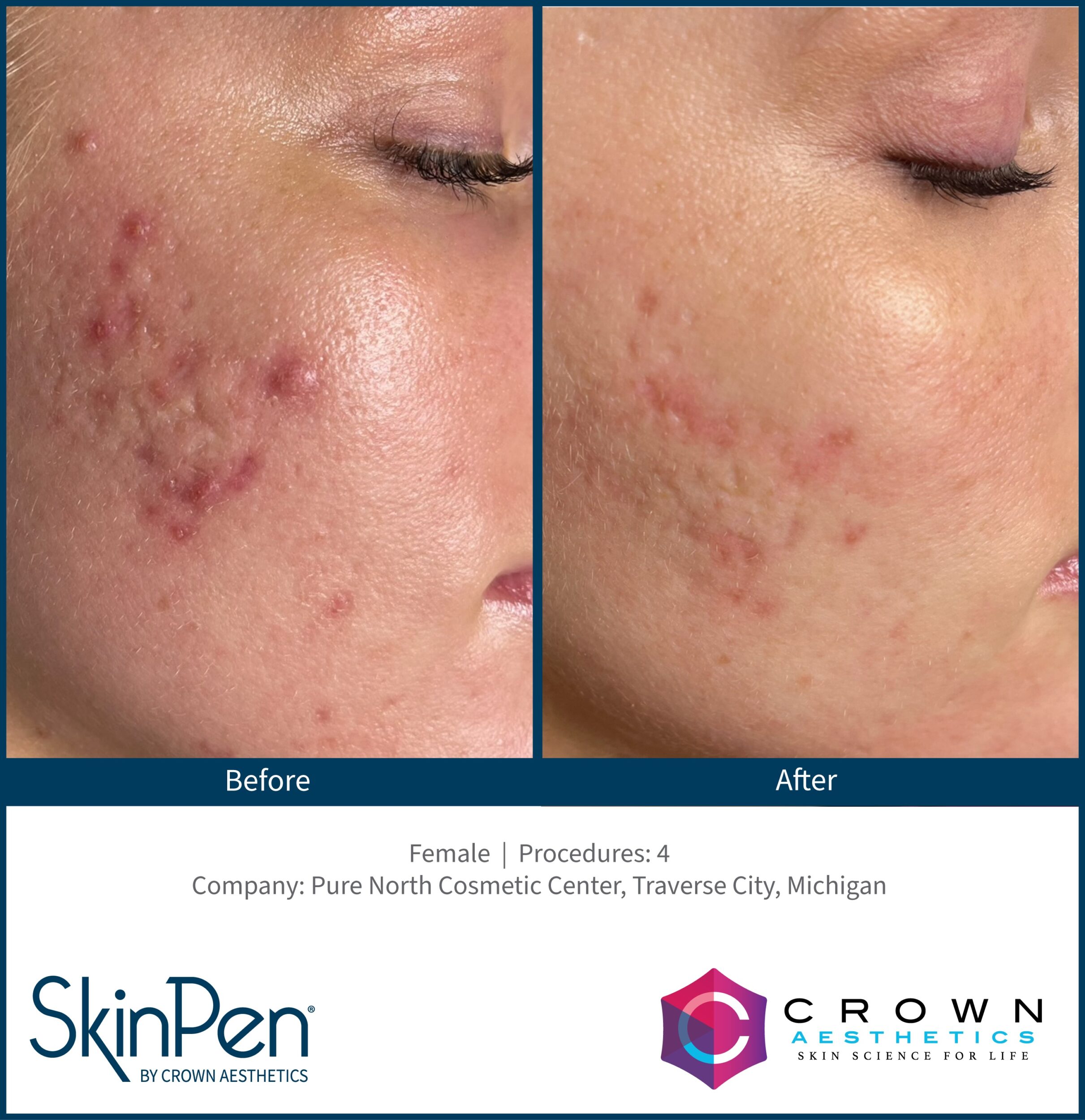 Before and After Image: SkinPen Microneedling - right-front-oblique