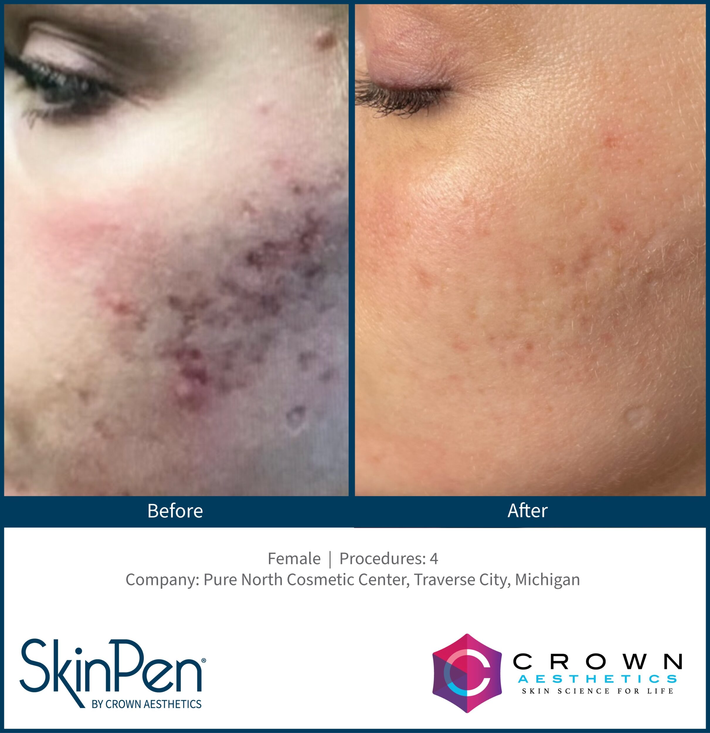 Before and After Image: SkinPen Microneedling - left-side