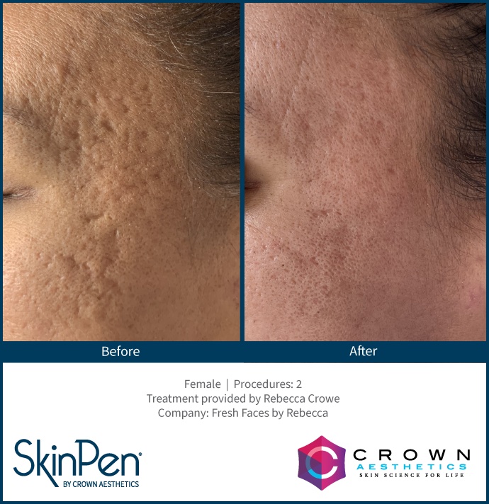 Before and After Image: SkinPen Microneedling - left-side