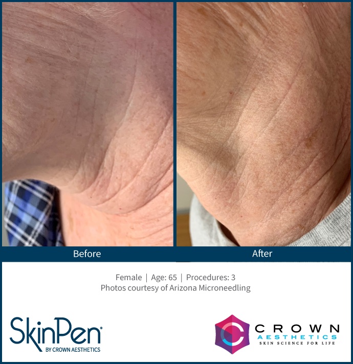 Before and After Image: SkinPen Microneedling - left-side