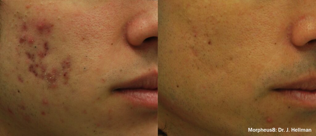 Before and After Image: Face Resurfacing - right-front-oblique
