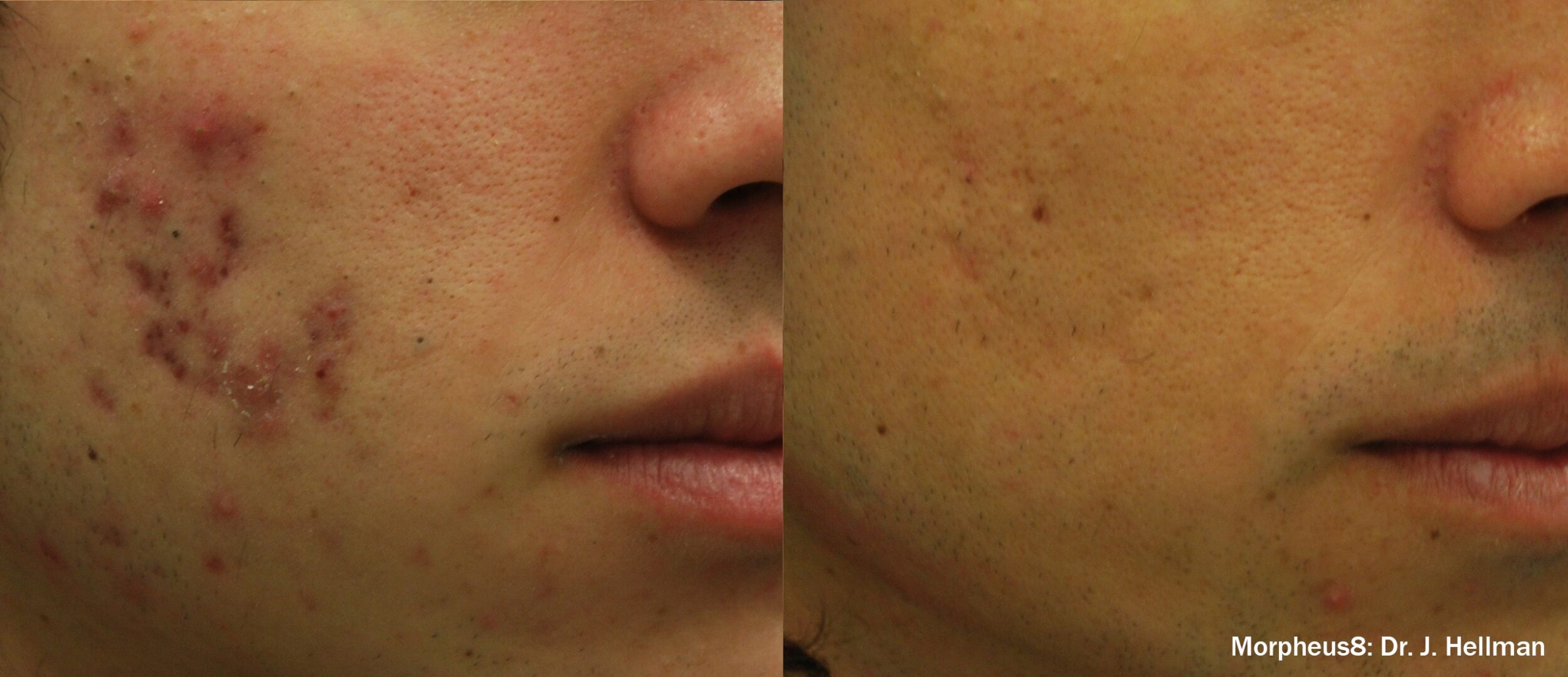 Before and After Image: Face Resurfacing - right-front-oblique