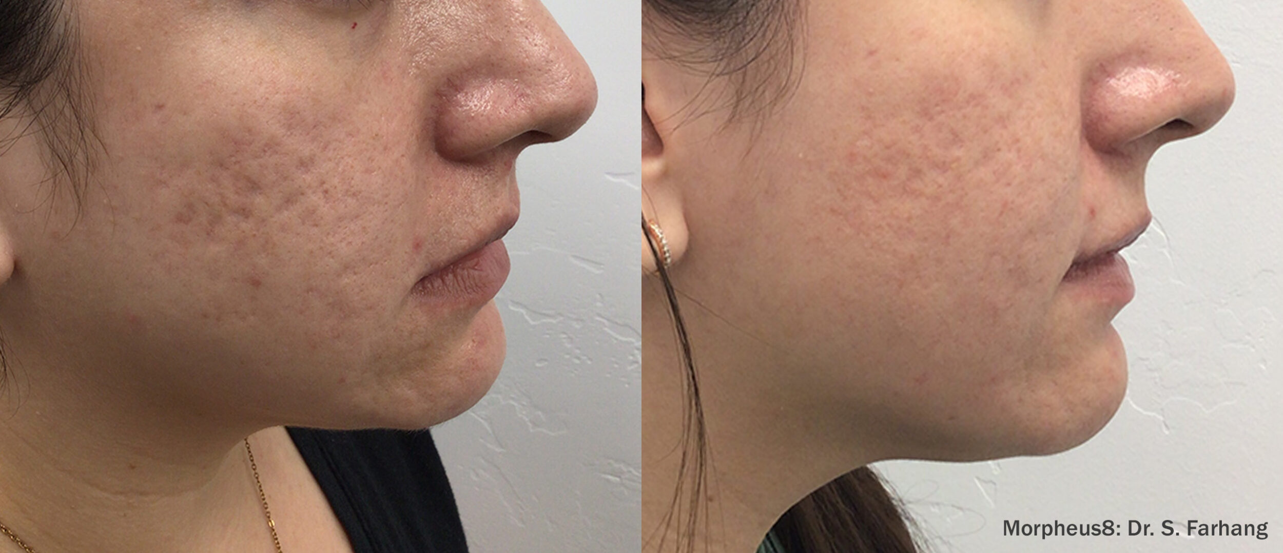 Before and After Image: Face Resurfacing - right-side