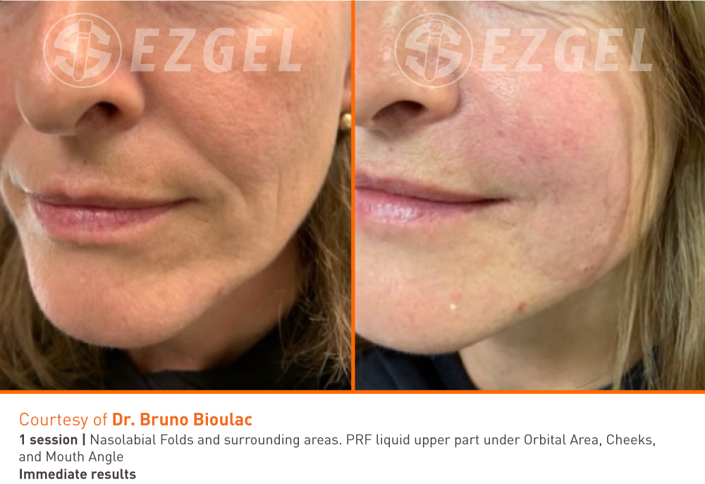 Before and After Image: PRF EZGel Lower Face - left-front-oblique