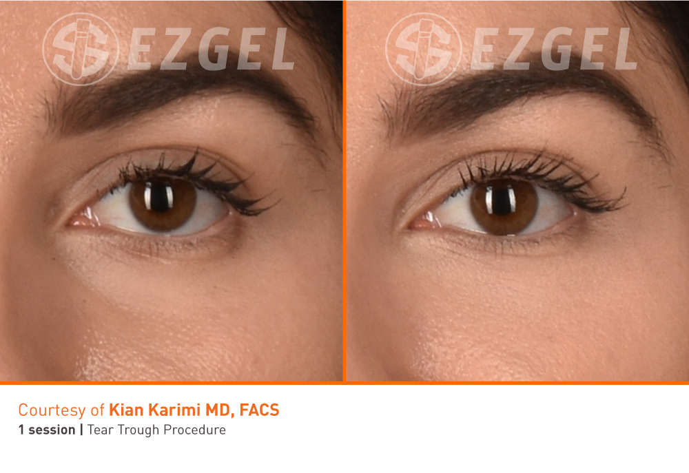 Before and After Image: PRF EZGel Undereyes - front