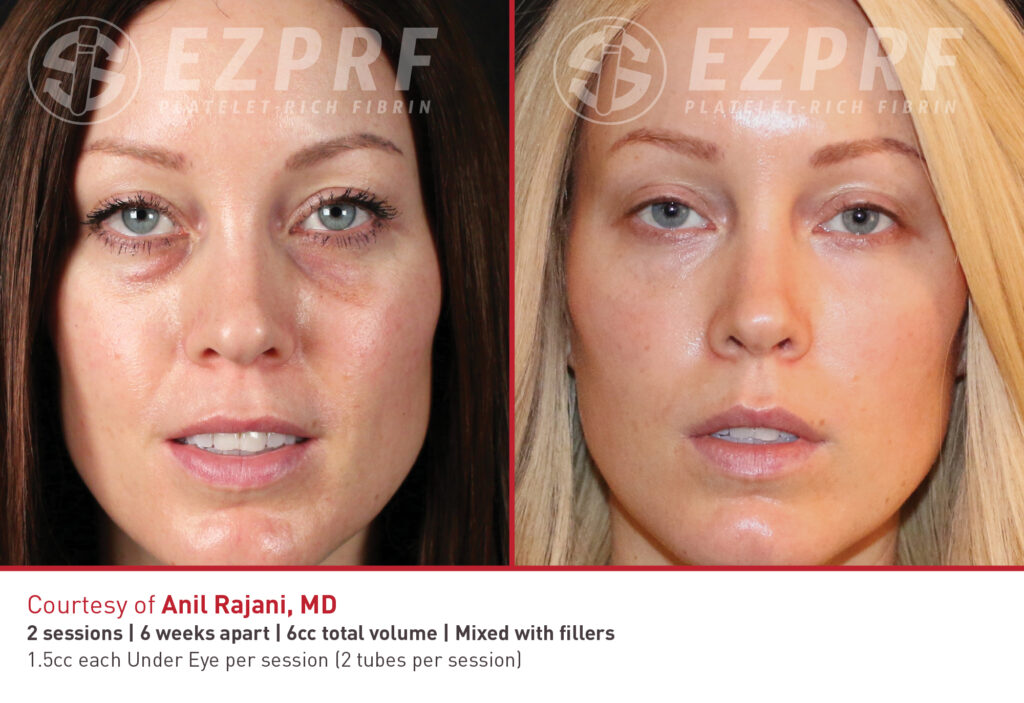 Before and After Image: PRF EZGel Undereyes - front