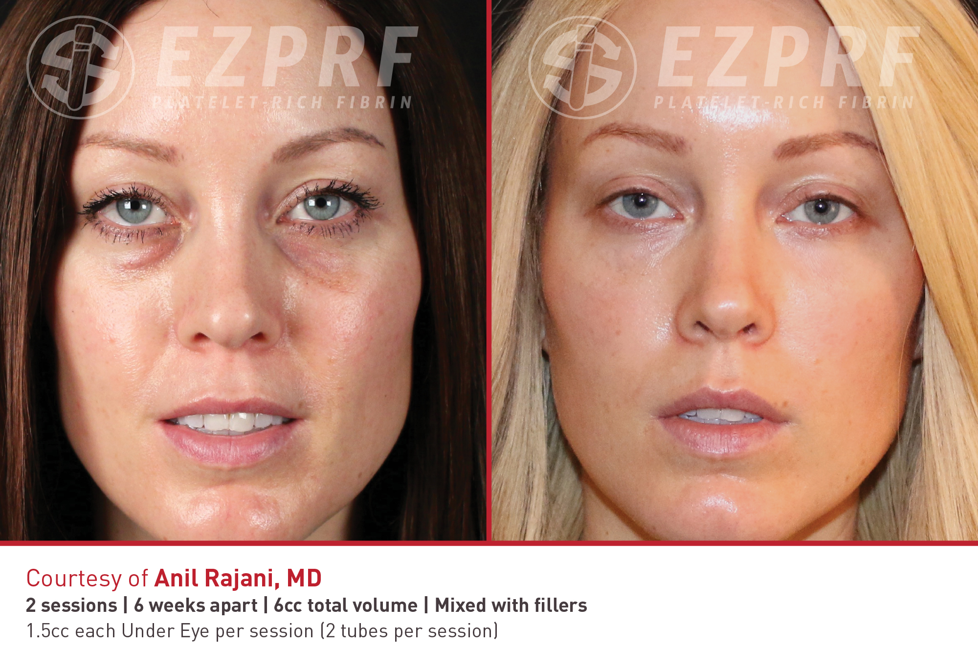 Before and After Image: PRF EZGel Undereyes - front