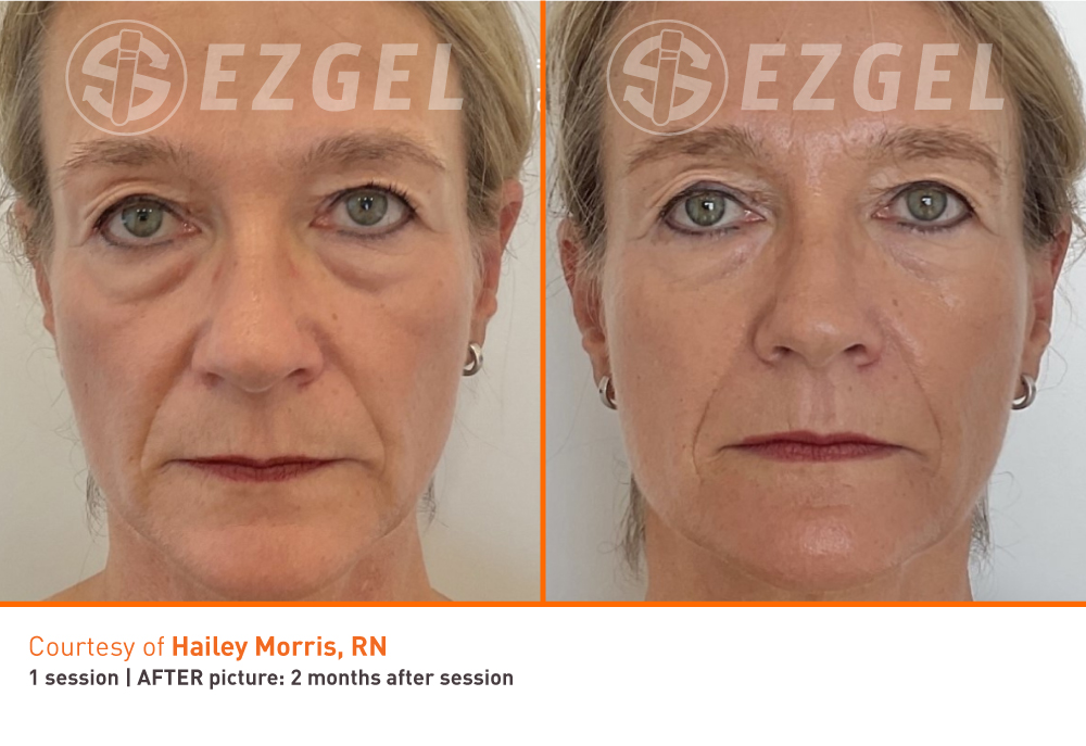 Before and After Image: PRF EZGel Full - front
