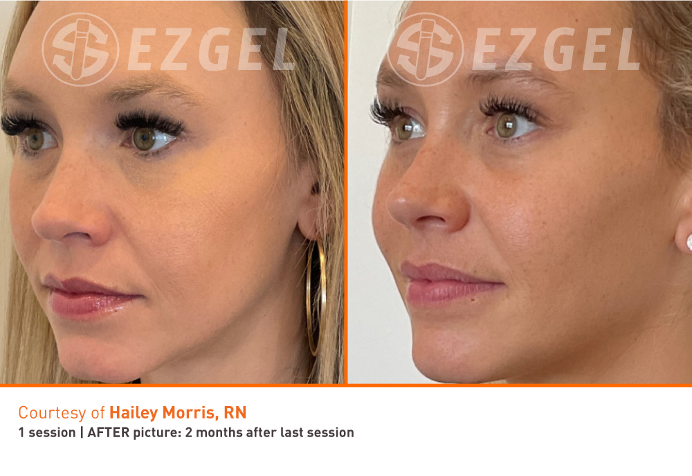 Before and After Image: PRF EZGel Full - left-front-oblique