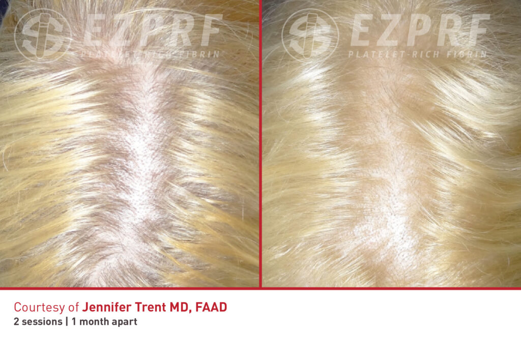Before and After Image: PRF Hair - front