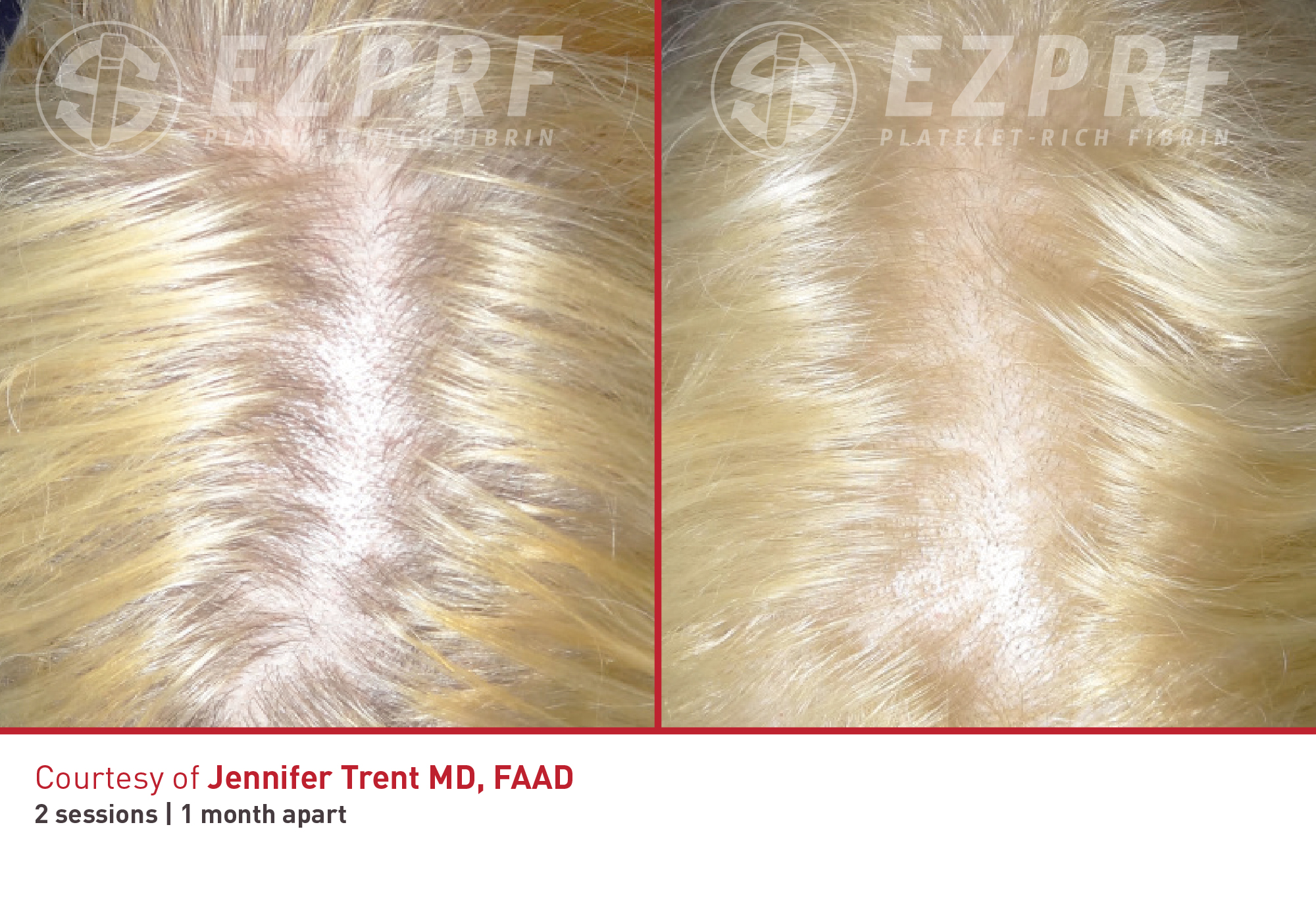 Before and After Image: PRF Hair - front