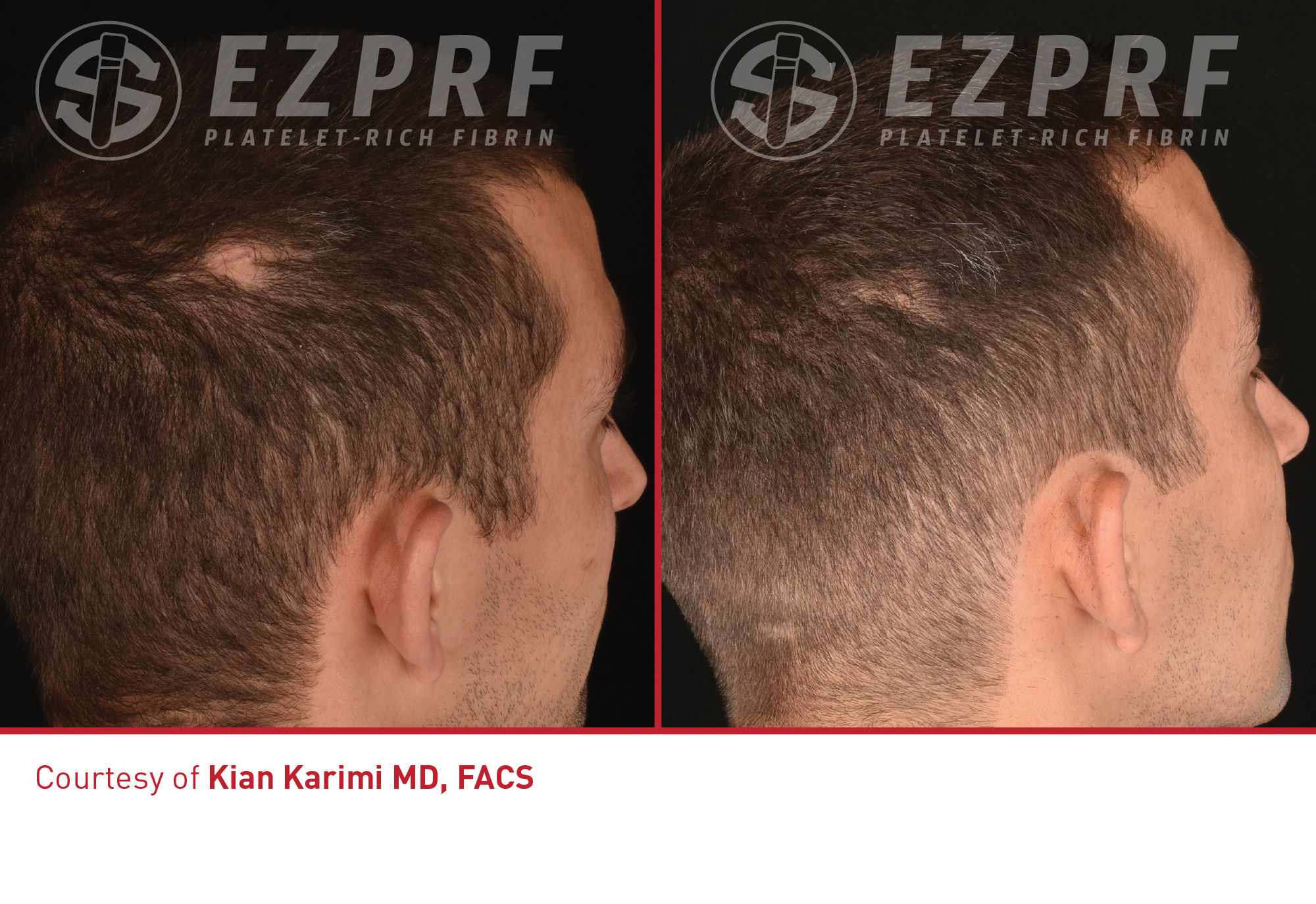 Before and After Image: PRF Hair - right-back-oblique