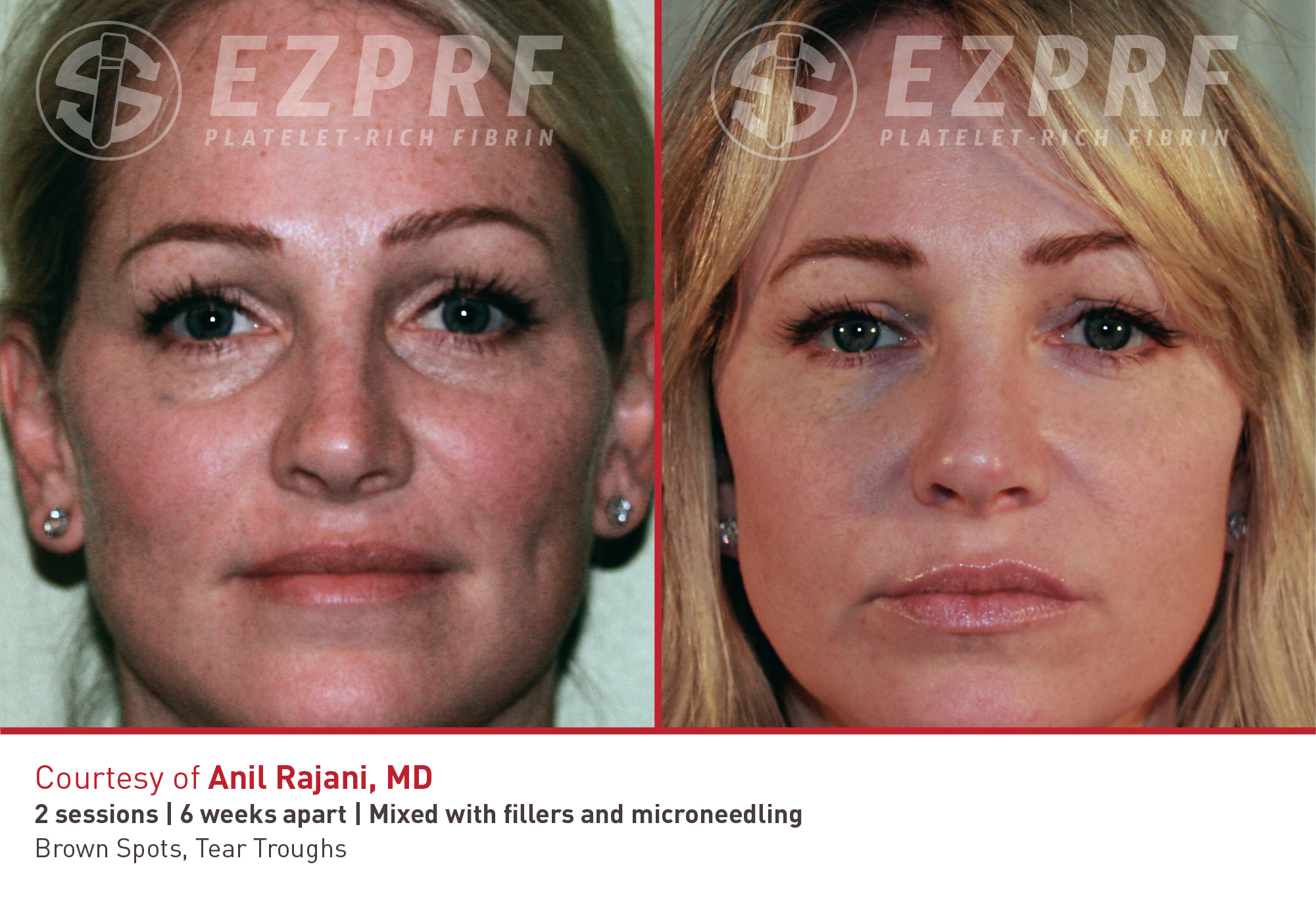 Before and After Image: PRF Undereyes - front