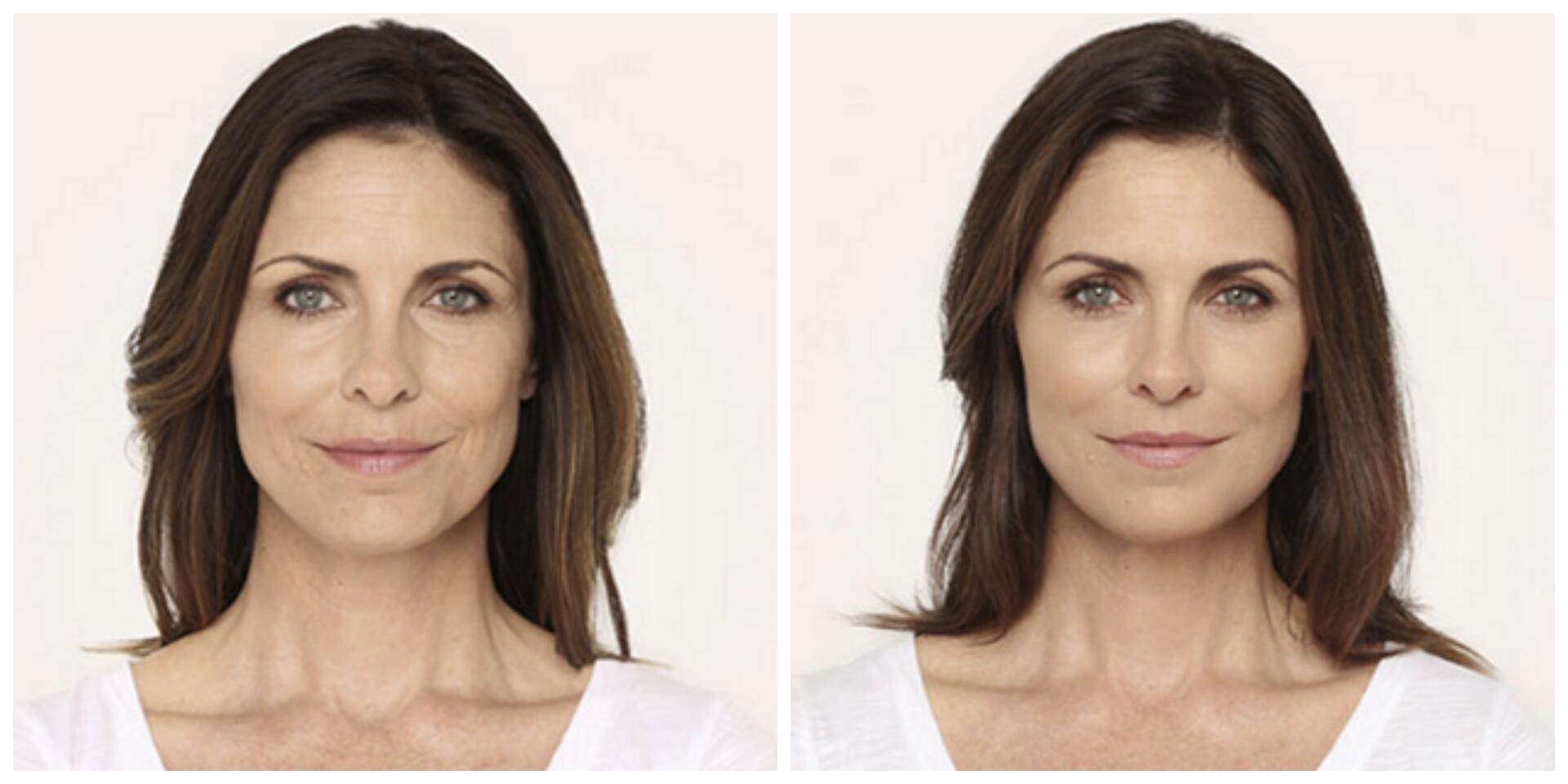 Before and After Image: Radiesse – Face - front