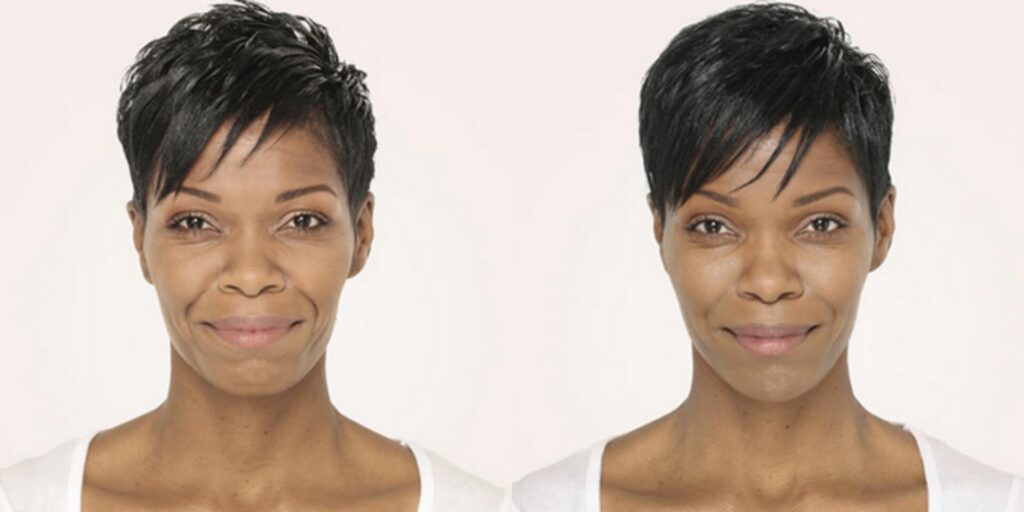 Before and After Image: Radiesse – Face - front