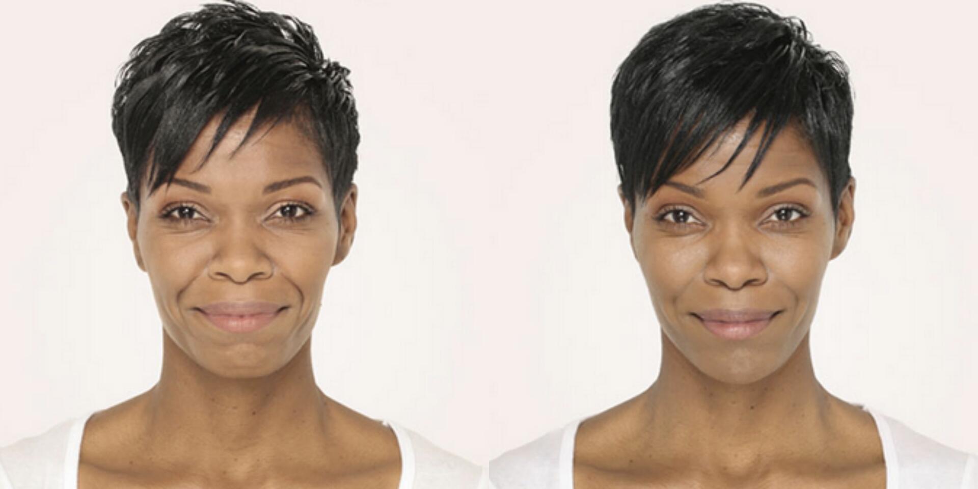 Before and After Image: Radiesse – Face - front
