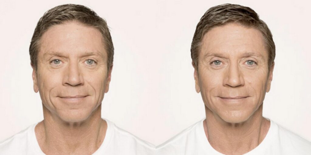 Before and After Image: Radiesse – Face - front