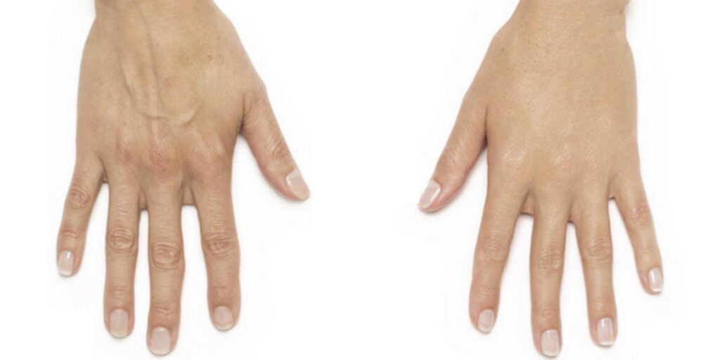 Before and After Image: Radiesse – Hands - front