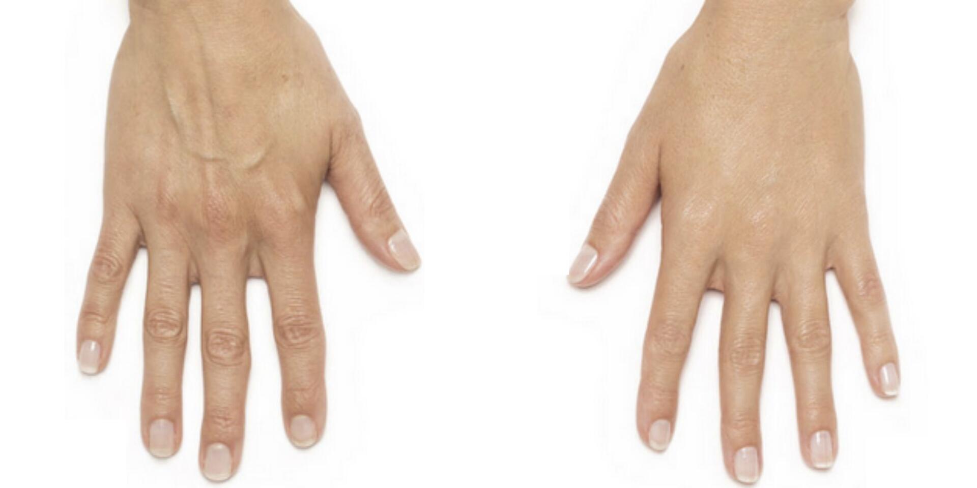 Before and After Image: Radiesse – Hands - front