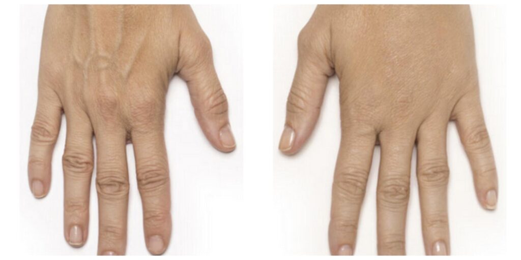 Before and After Image: Radiesse – Hands - front