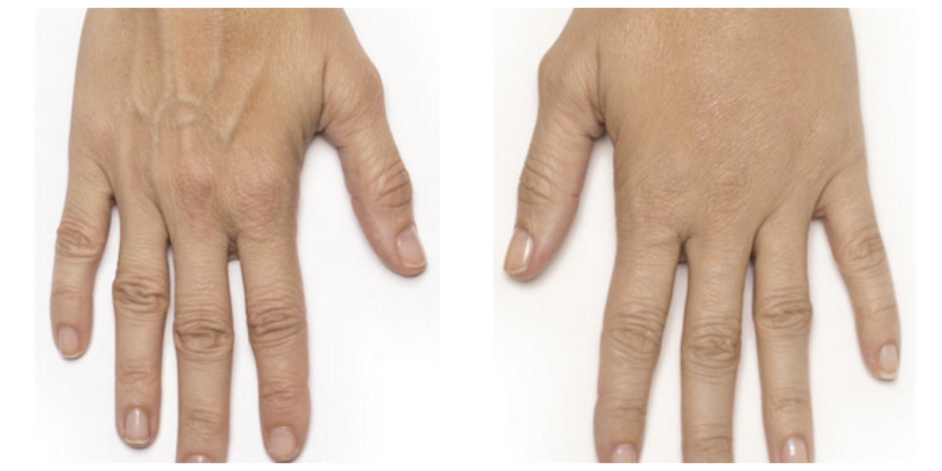 Before and After Image: Radiesse – Hands - front