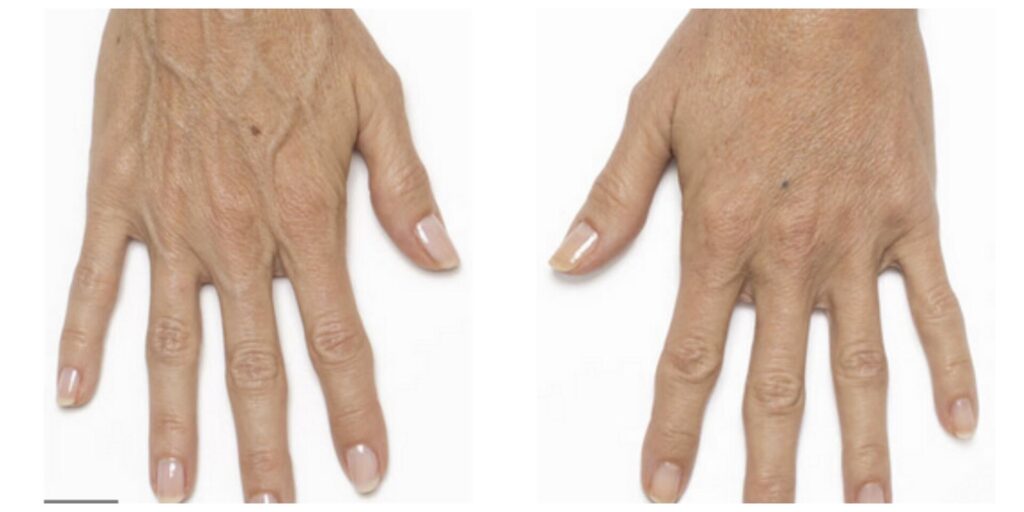 Before and After Image: Radiesse – Hands - front