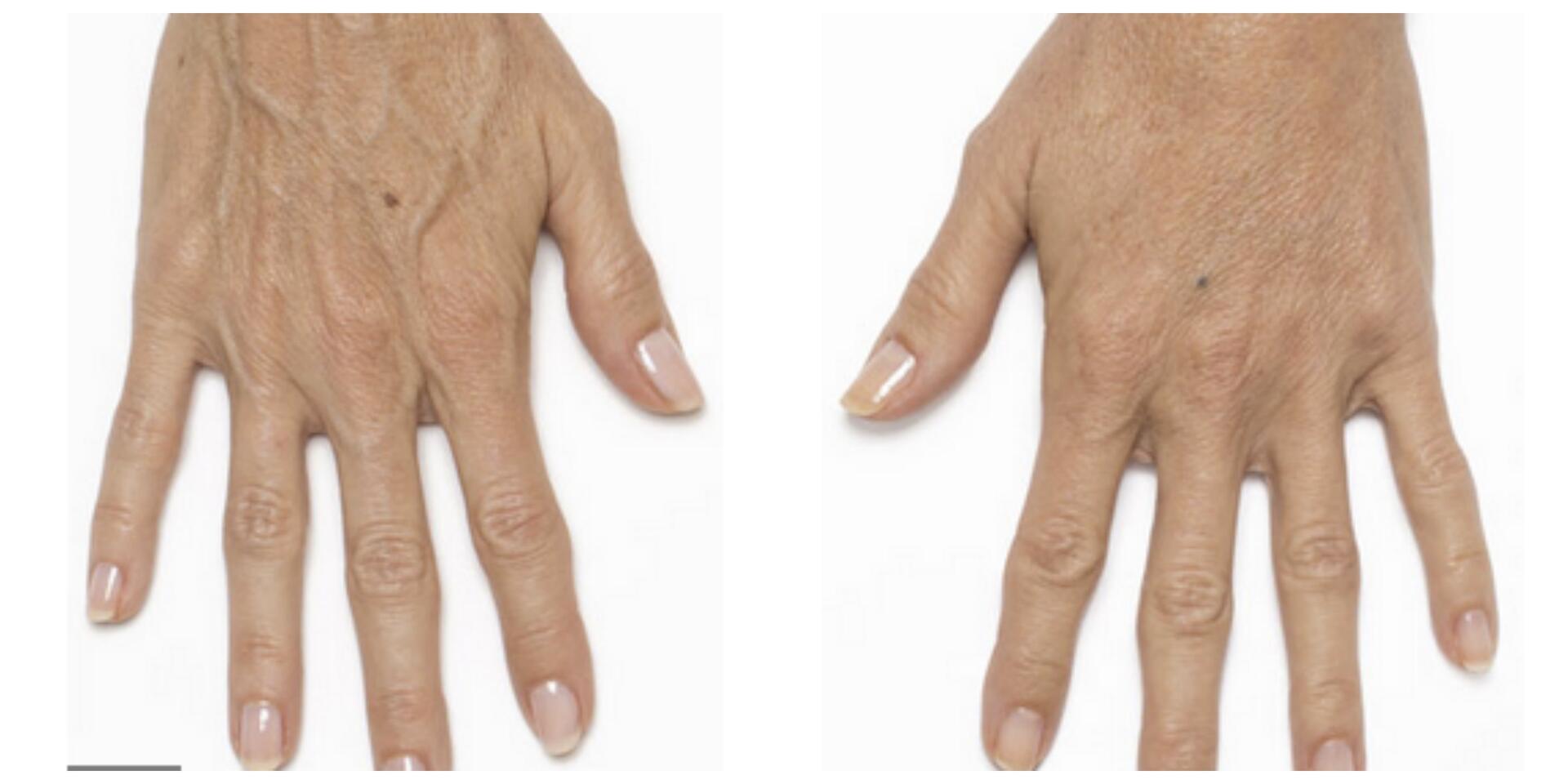 Before and After Image: Radiesse – Hands - front