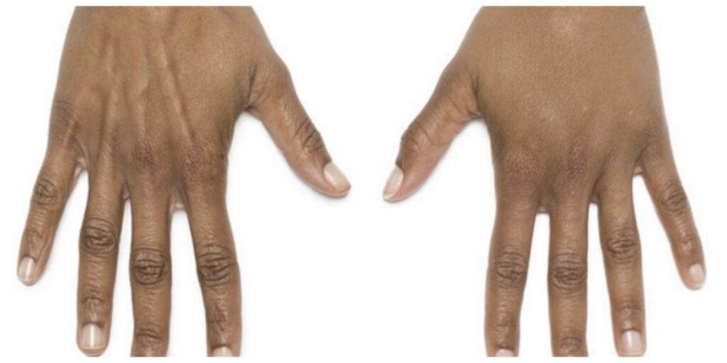 Before and After Image: Radiesse – Hands - front