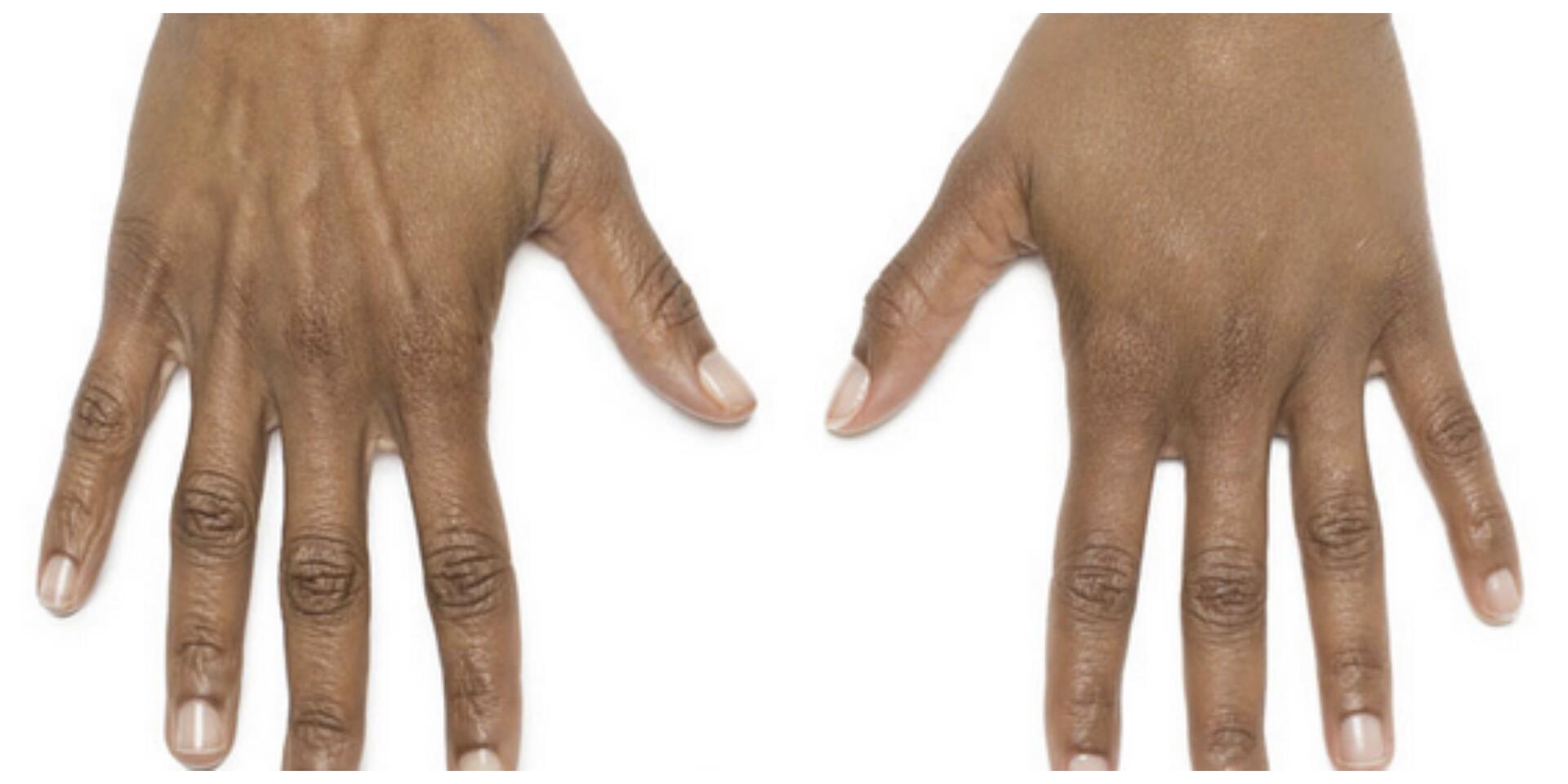 Before and After Image: Radiesse – Hands - front