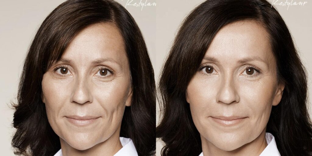 Before and After Image: Restylane - front