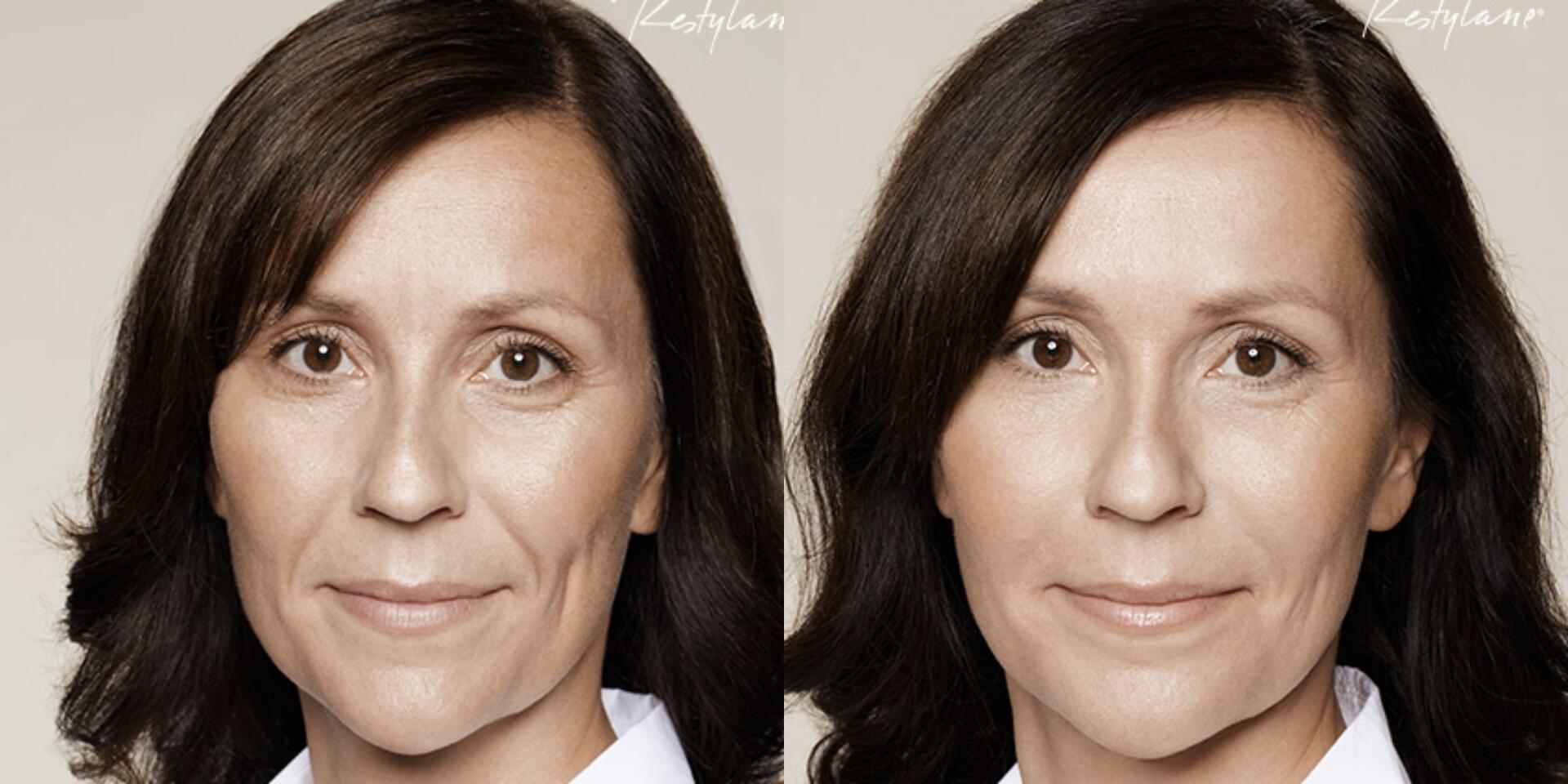 Before and After Image: Restylane - front