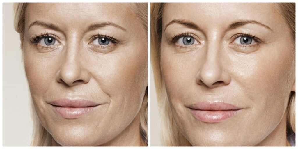 Before and After Image: Restylane - left-front-oblique