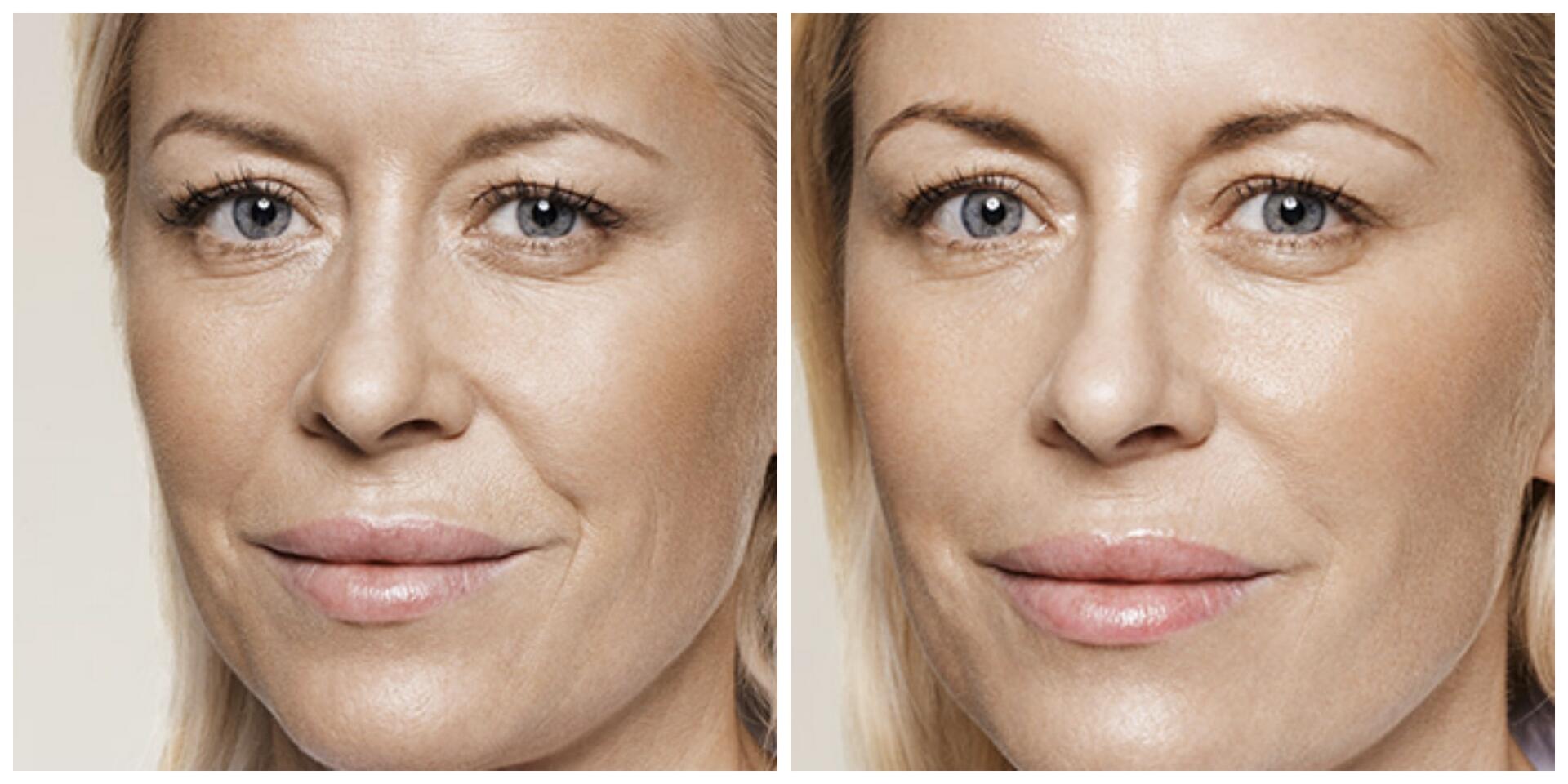 Before and After Image: Restylane - left-front-oblique