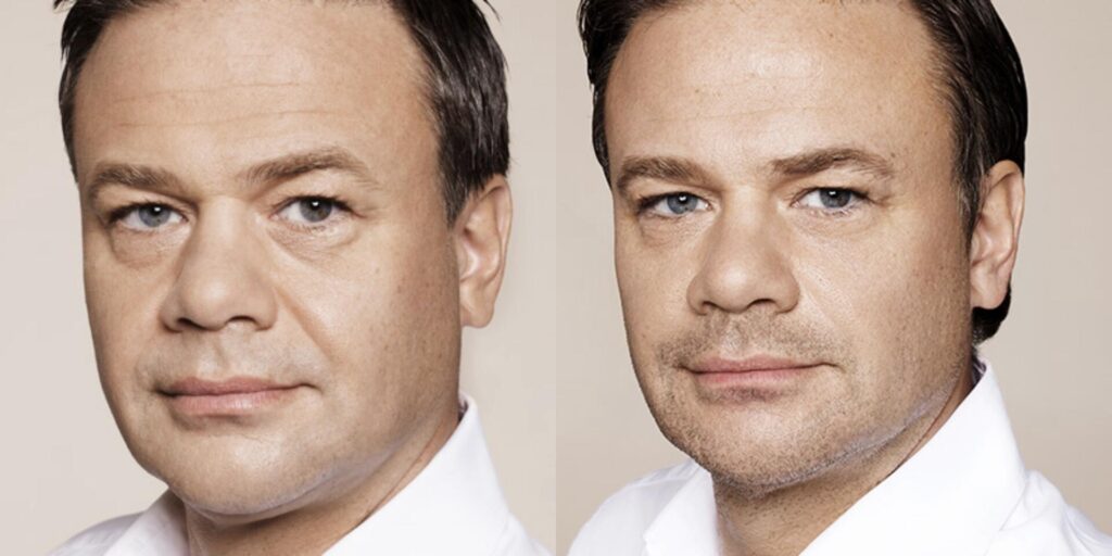 Before and After Image: Restylane - left-front-oblique