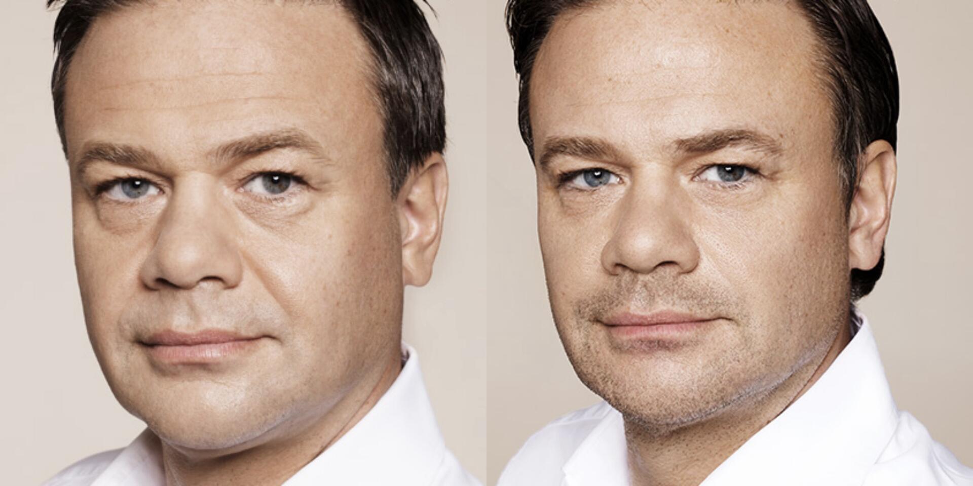 Before and After Image: Restylane - left-front-oblique