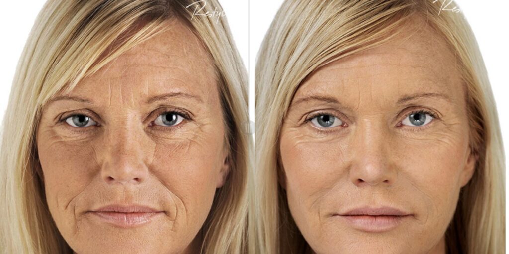 Before and After Image: Restylane - front