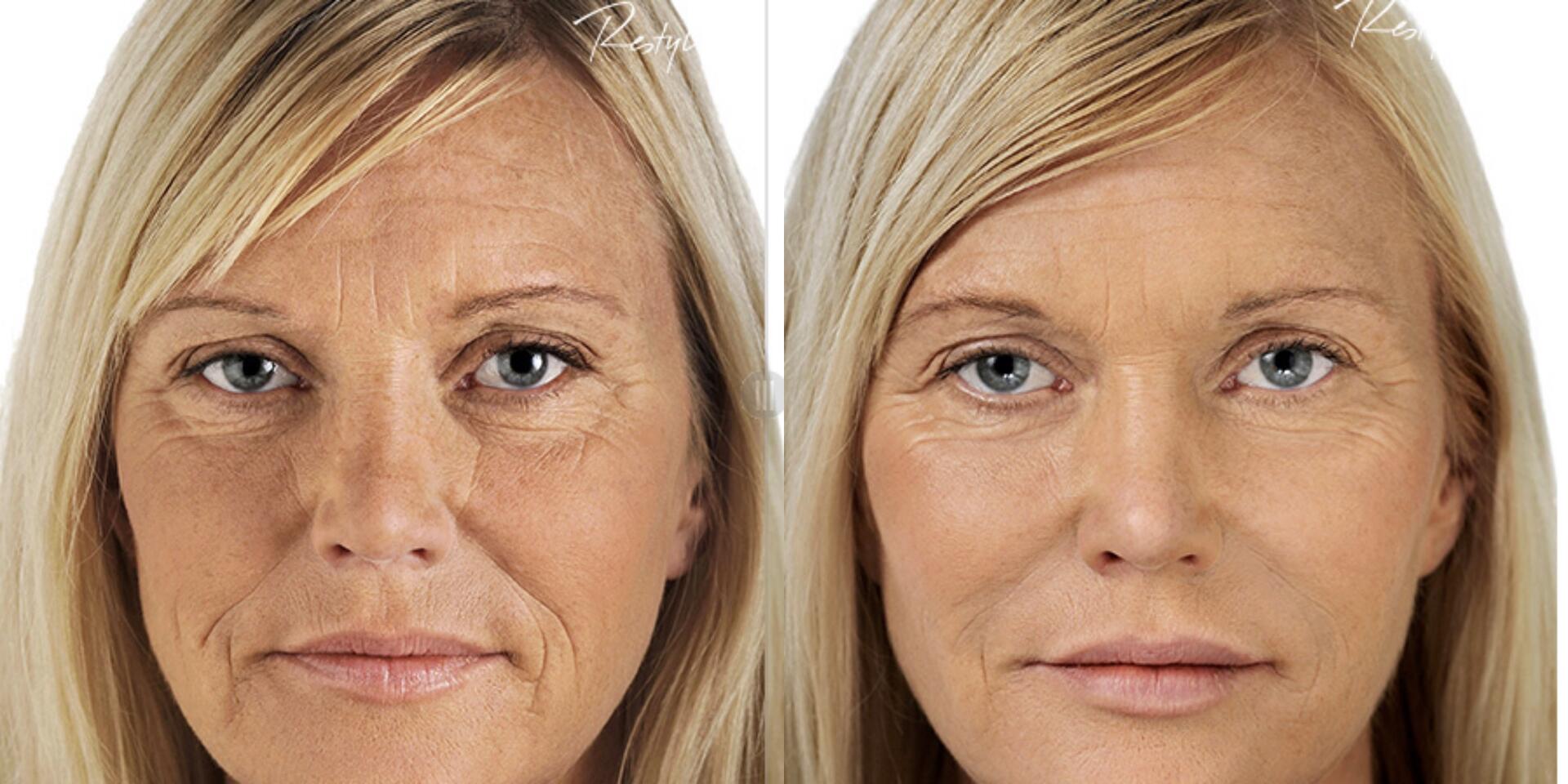 Before and After Image: Restylane - front