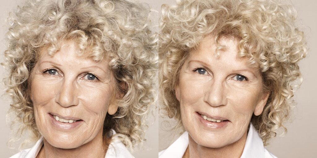 Before and After Image: Restylane - left-front-oblique